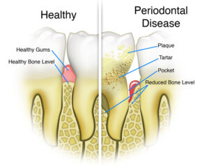 healthy vs non healty gums